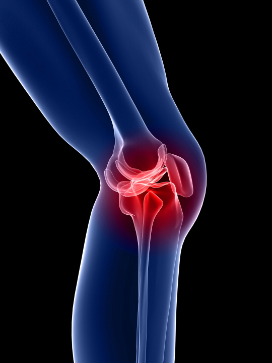 무릎관절질환의 증상과 치료 (사진=DB) 
