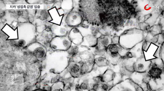 지카바이러스 주요증상 (사진=방송캡처) 