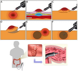 한국맥널티의 내시경 점막하 투입제 개념도