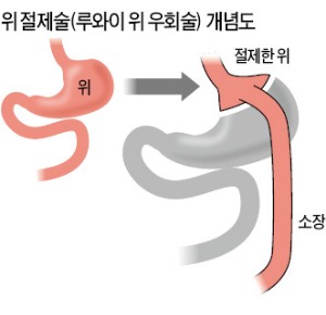 당뇨환자 5명중 3명은 비만…합병증 위험도 4배 이상