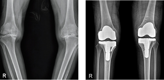 심한 퇴행성관절염 때문에 O자형으로 변한 무릎(왼쪽)과 인공관절 수술을 받은 뒤 교정된 무릎의 X레이 사진