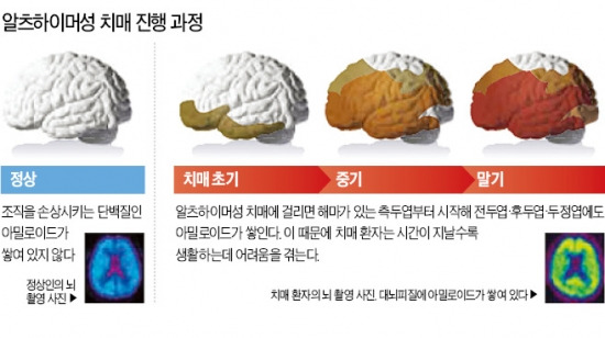 [건강한 인생] 빨라지는 치매 시계…작년 65세이상 54만명 걸려