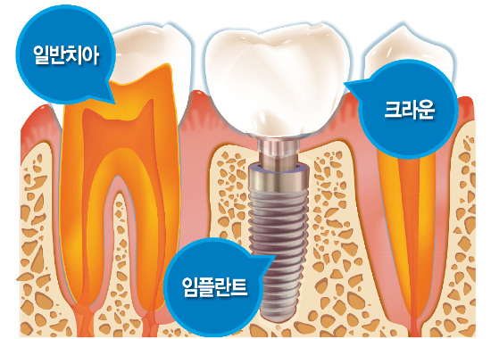 [건강한 인생] 엠앤씨덴탈'미래형 인공치아'…크라운 '지르코스-이' 실제 치아 같아 좋네!