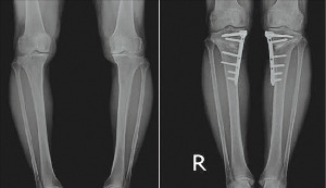 휜다리 교정술을 받기 전(왼쪽)과 후의 모습.  