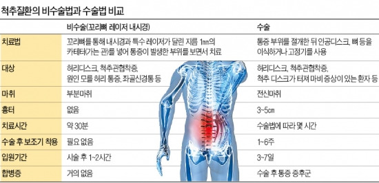 [건강한 인생] '꼬리뼈 레이저 내시경'의 마술…메스 안대고 허리디스크 고친다