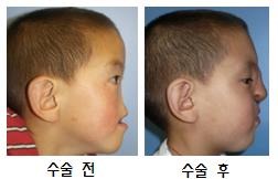 안면기형 소년의 수술 전후 모습 비교. 서울성모병원 제공.