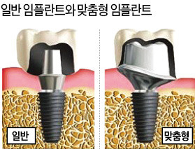 [건강한 인생] 에스플란트치과병원 3D 임플란트, 잇몸 상태 맞춰 최적 위치에 시술…염증 적고 회복 빨라