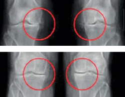 줄기세포 치료 전 환자의 무릎 엑스레이 사진(위)과 수술 1년 후 엑스레이 사진. 수술 전 연골이 닳아 맞닿아 있는 무릎뼈가 연골이 자라면서 떨어졌다. /연세사랑병원 제공