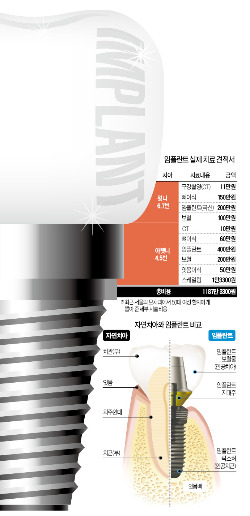 임플란트 병원따라 수백만원 차이…더 싼 곳? 더 비싼 곳?…아~ 고민되네