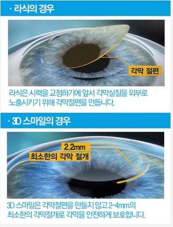 기존 라식 부작용 보완한 3D 스마일라식 인기