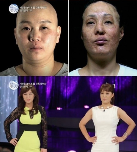 렛미인 괴물 엄마와 털없는 엄마의 아름다운 변신…시청자 감동 | 한국경제