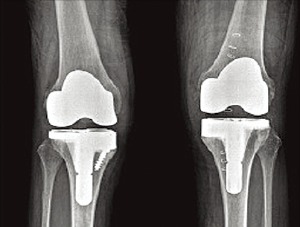 심한 퇴행성 관절염 때문에 O자형으로 변한 무릎(위)과 인공관절 수술을 받은 뒤 교정된 무릎의 X레이 사진.  