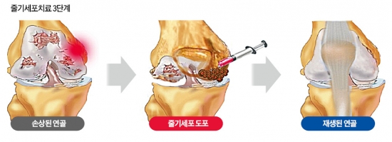 [Health] 환절기 무릎 관절염…줄기세포로 치료하세요