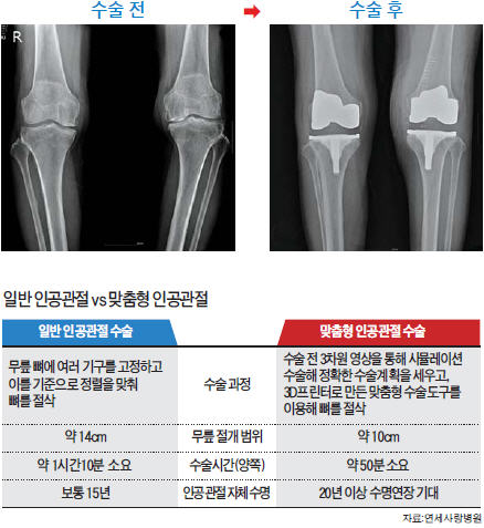 [건강한 인생] 3D프린터로 만든 맞춤형 인공관절, 정확성·안전성…모두 딱 맞췄네요!