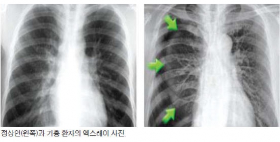 키 훌쩍 자란 10~20대 남성, 가슴 답답함 느낄 땐 기흉 의심해야