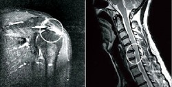 회전근개가 파열된 환자(왼쪽)와 목 디스크 환자의 MRI(자기공명영상) 사진. 바른세상병원 제공