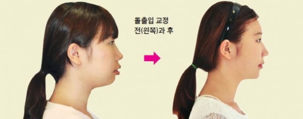 [메디컬 이슈] 자신감 떨어뜨리는 돌출입…치아교정만으로 무턱·잇몸노출 해결