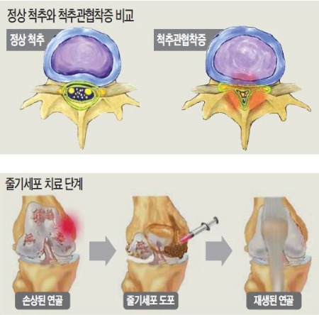 [건강한 인생] 허리 통증 부위에 특수관 투입…수술 없이 20분이면 증상 완화