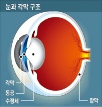 뻑뻑하고 흐릿해진 눈…난시와 근시 동시에 잡으세요