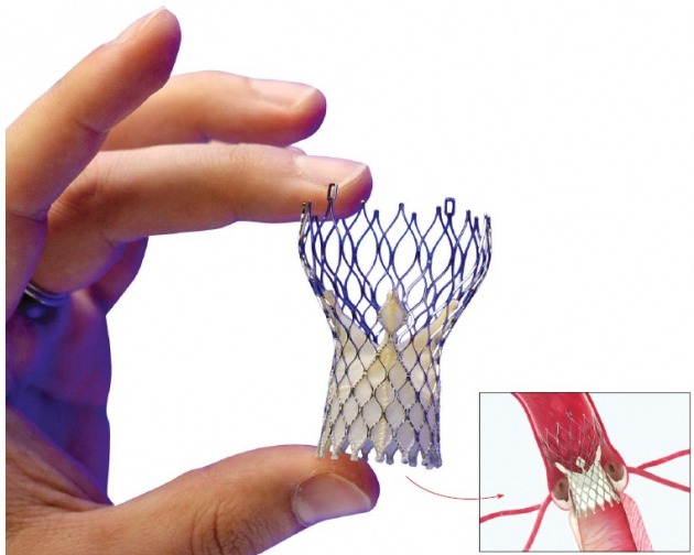 메드트로닉사가 만든 심장 수술 없이 혈관을 넓혀줄 수 있는 코어밸브. 
