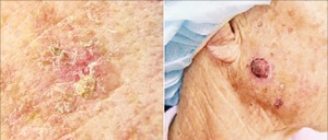 광선각화증(왼쪽)과 편평세포암.  