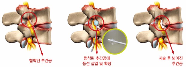 [Health] 힘찬병원, 허리통증 시술환자 1000명 조사…풍선확장술, 척추관협착증 치료에 효과