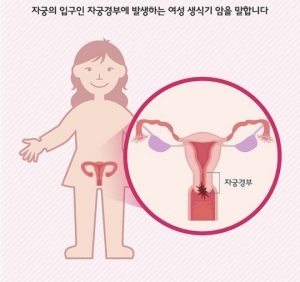 [실검보고서]&#39;힐링캠프&#39; 김제동 눈물 사연 속 자궁경부암과 예방법은 무엇?