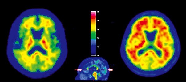 왼쪽은 정상, 오른쪽은 알츠하이머 치매. 