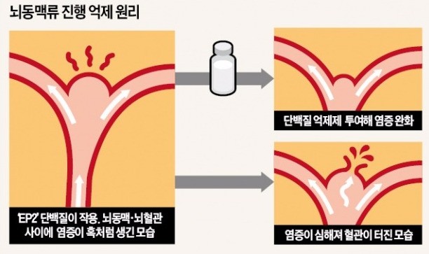 '머릿속 폭탄' 뇌동맥류, 약물치료 가능성 열려