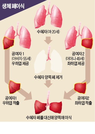 부모 폐 일부 떼내 딸에게…법 위반 감수하고 환자 살린 병원