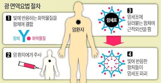 [재팬리포트]빛으로 암 저격하는 '광 면역요법', 日서도 임상 시작