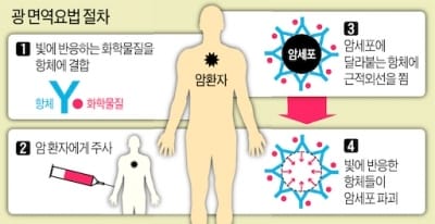 빛으로 암 저격하는 '광 면역요법', 日서도 임상 시작