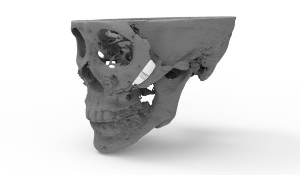 시지바이오, 3D프린팅 인공광대뼈 제조 허가 받아