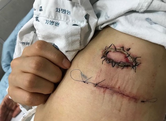 차병원, 한예슬 지방종 수술 의료사고 경위 밝혀 (사진=SNS)