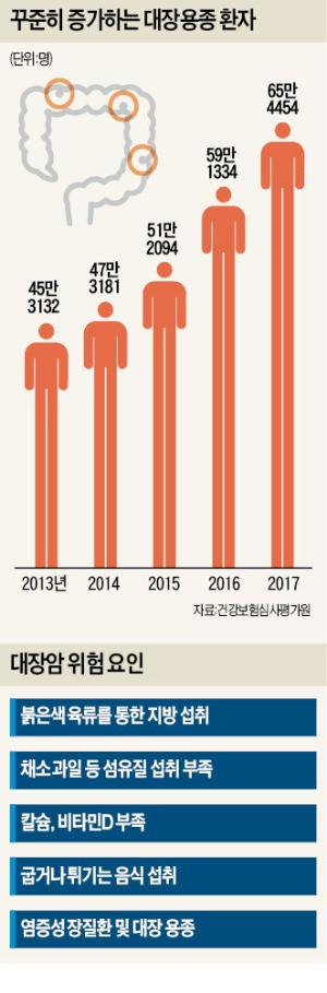 3명 중 1명 생기는 '대장암 씨앗' 용종… 운동 부족 땐 9배 더 위험