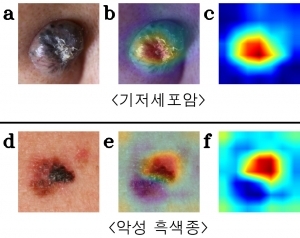 "인공지능에 피부암 학습시켰더니 의사만큼 암 잘 찾아"