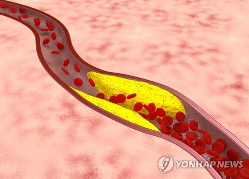 "'좋은' 콜레스테롤 너무 많아도 감염에 취약"