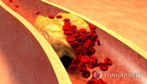 "콜레스테롤 수치 변화 심한 사람, 사망률 26% 높다"