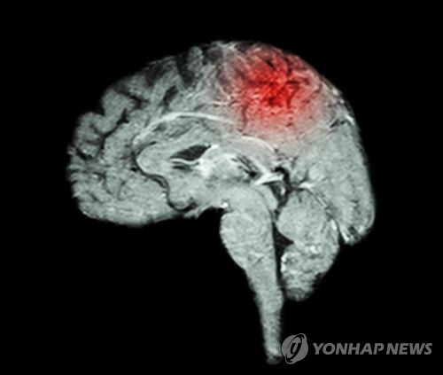 美 연구팀, 뇌졸중 손상 뇌 조직 재생 '젤' 개발