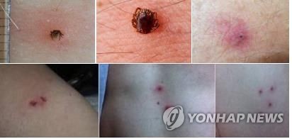 "야생진드기 조심해야"…원주서 'SFTS' 사망자 잇따라