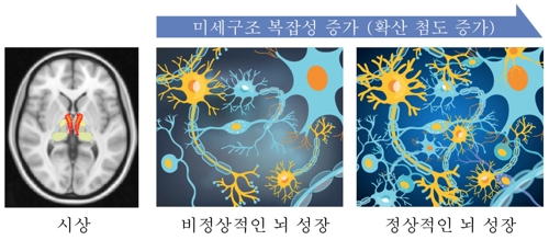 "미숙한 뇌 발달이 조현병 부른다"