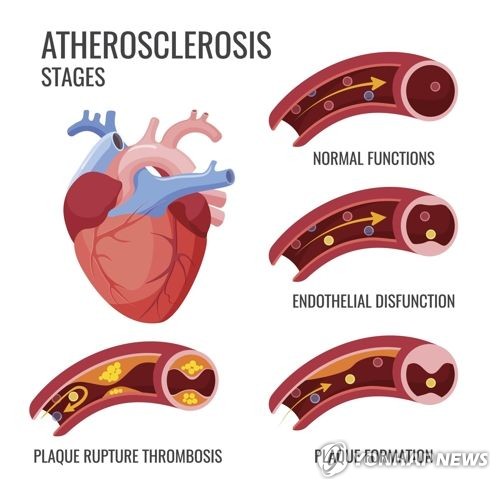 "젊어도 뚱뚱하면 심근경색·협심증 위험 최대 97%↑"