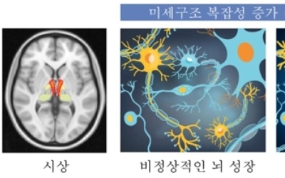 "미숙한 뇌 발달이 조현병 부른다"