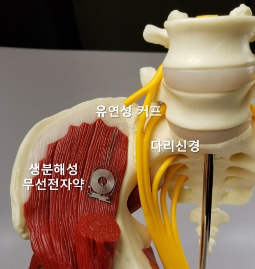 신경치료 후 몸에서 자연 분해되는 '전자약' 나왔다