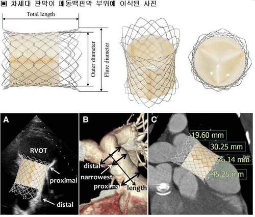 국산 인공심장판막 첫 등장…3000만∼4000만원 수입산 대체