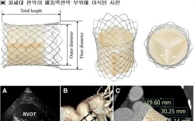 국산 인공심장판막 첫 등장…3000만∼4000만원 수입산 대체