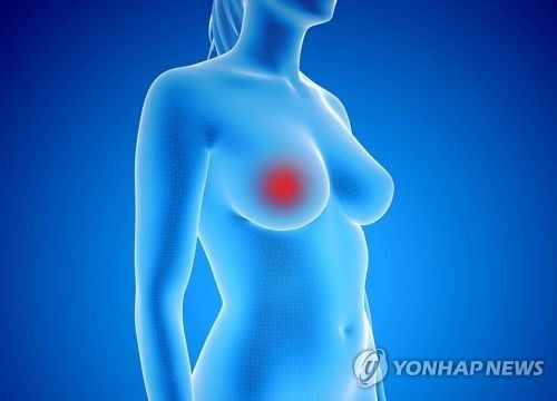 英 연구팀, 유방암 위험 '계산기' 개발