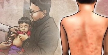 미국도 홍역 확산…워싱턴주, 확진환자 35명·비상사태 선포