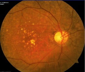 드루젠 이상 소견을 받은 환자의 안저 촬영 사진. 가운데 왼쪽 부분의 불규칙한 노란 점.
 