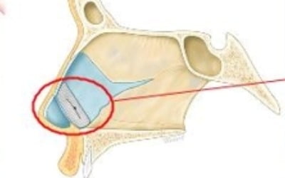 '휘어진 코' 이제 3D 프린팅 기술로 고친다